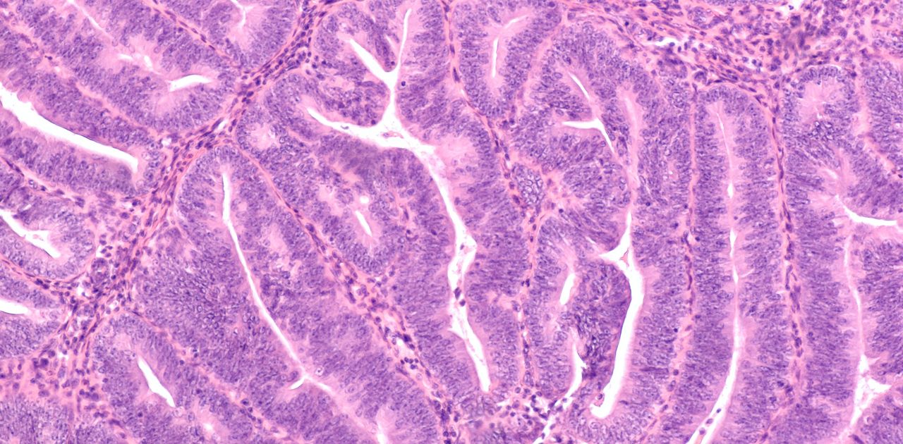Microscopic image of complex endometrial hyperplasi