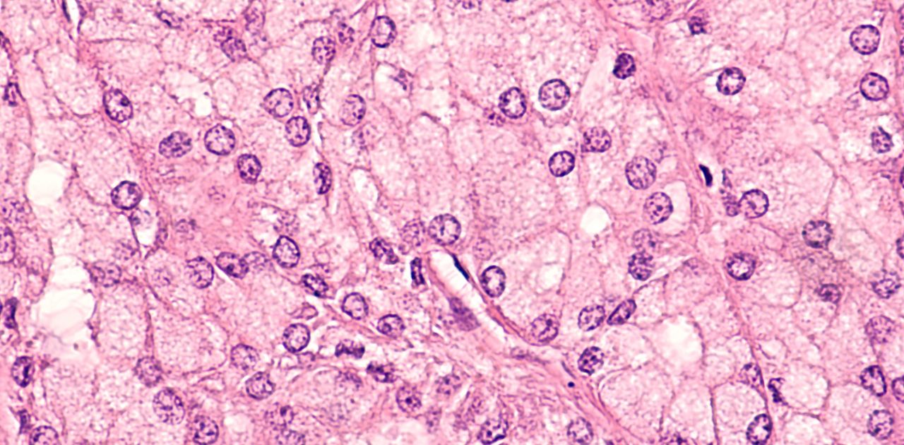 Microscopic image of an acinic cell carcinoma
