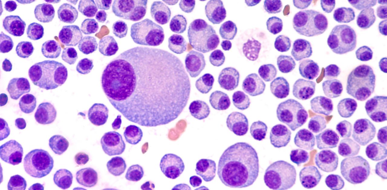 Bone marrow aspirate cytology of multiple myeloma,