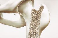 Osteoporosis stage 4 of 4 - upper limb bone - 3d rendering